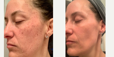 IPL before and after photo