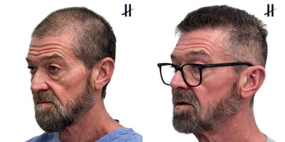 PRP for Hair Loss before and after photo