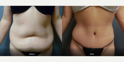 Tummy Tuck before and after photo