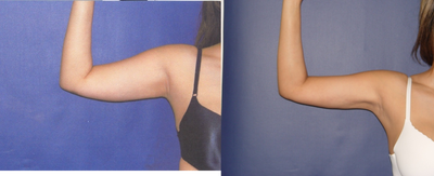 Vaser Liposuction before and after photo