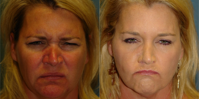 Botox before and after photo