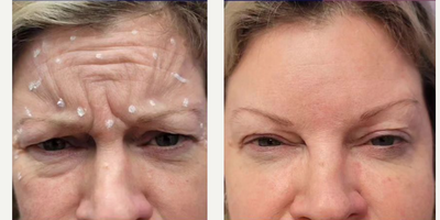 Botox before and after photo