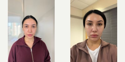 Buccal Fat Removal before and after photo