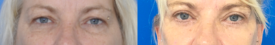 Eyelid Surgery before and after photo
