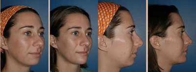 Rhinoplasty before and after photo