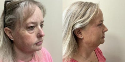 CO2 Laser before and after photo