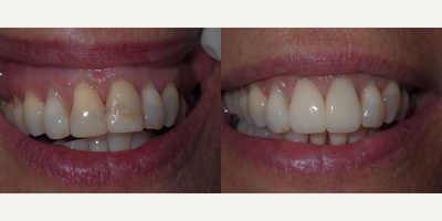 Dental Crown before and after photo