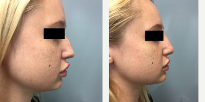 Juvederm before and after photo