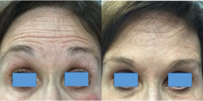 Xeomin before and after photo