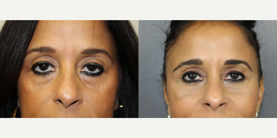 Eyelid Surgery before and after photo