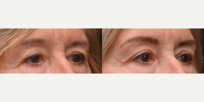 Eyelid Surgery before and after photo