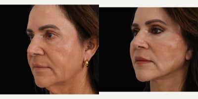 Facelift before and after photo