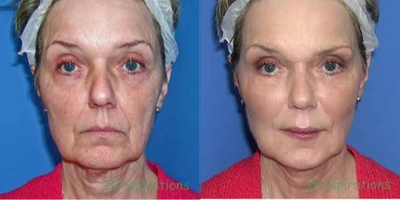 Liquid Facelift before and after photo