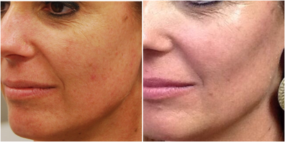 Voluma before and after photo