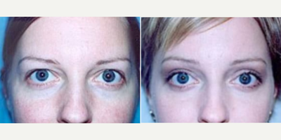 Brow Lift before and after photo