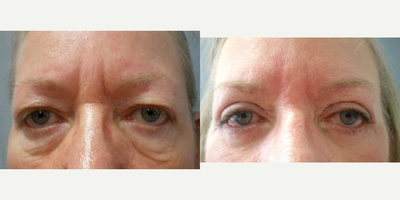 Eyelid Surgery before and after photo