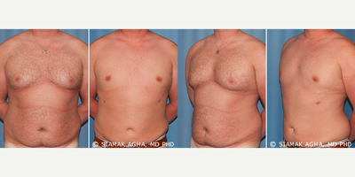 Liposuction before and after photo