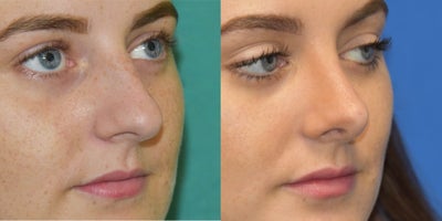 Rhinoplasty before and after photo