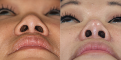 Asian Rhinoplasty before and after photo