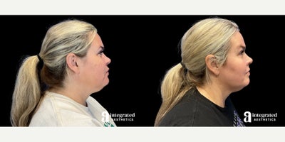 Chemical Peel before and after photo