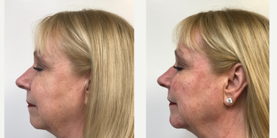 Dermal Fillers before and after photo