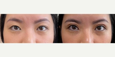 Double Eyelid Surgery before and after photo