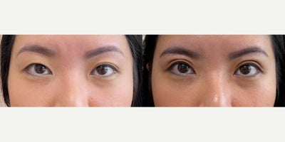 Double Eyelid Surgery before and after photo