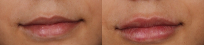Lip Fillers before and after photo