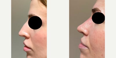Rhinoplasty before and after photo