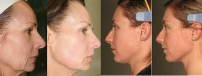 Ultherapy before and after photo
