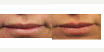 Volbella before and after photo