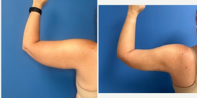 Arm Lift before and after photo