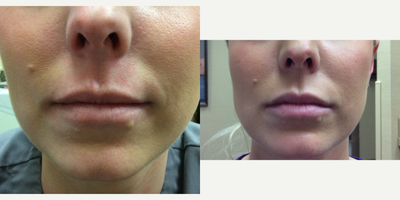 Dermal Fillers before and after photo