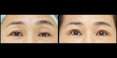 Eyelid Surgery before and after photo