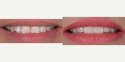 Porcelain Veneers before and after photo