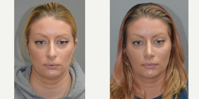 Rhinoplasty before and after photo