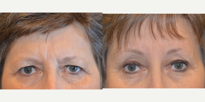 Brow Lift before and after photo