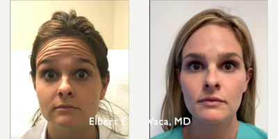 Dermal Fillers before and after photo