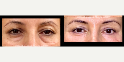 Eyelid Surgery before and after photo
