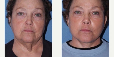 Facelift before and after photo
