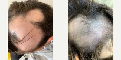 Hair Loss Treatment before and after photo