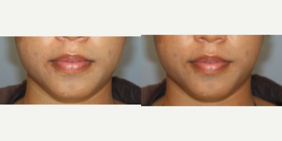 Juvederm before and after photo