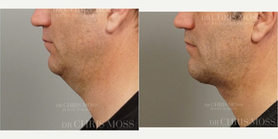 Neck Lift before and after photo