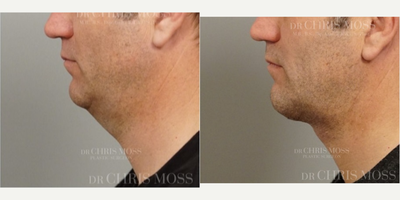 Neck Lift before and after photo