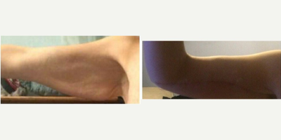 Arm Lift before and after photo