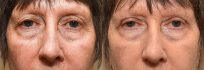 Eyelid Surgery before and after photo