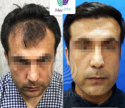 FUE Hair Transplant before and after photo