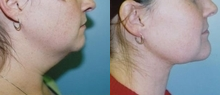 Liposuction before and after photo