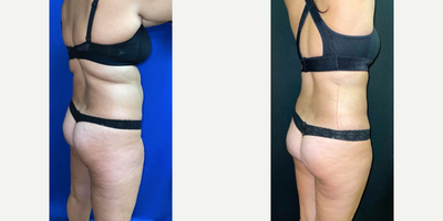 Liposuction before and after photo