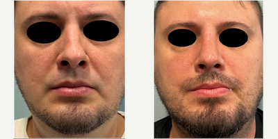 Revision Rhinoplasty before and after photo